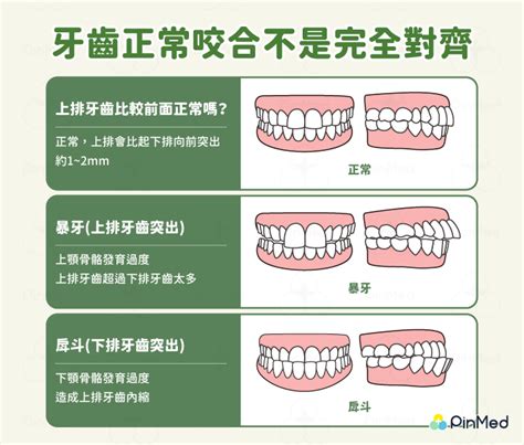 上排牙齒蓋住下排牙齒|咬合不正：症狀、原因、治療、預防